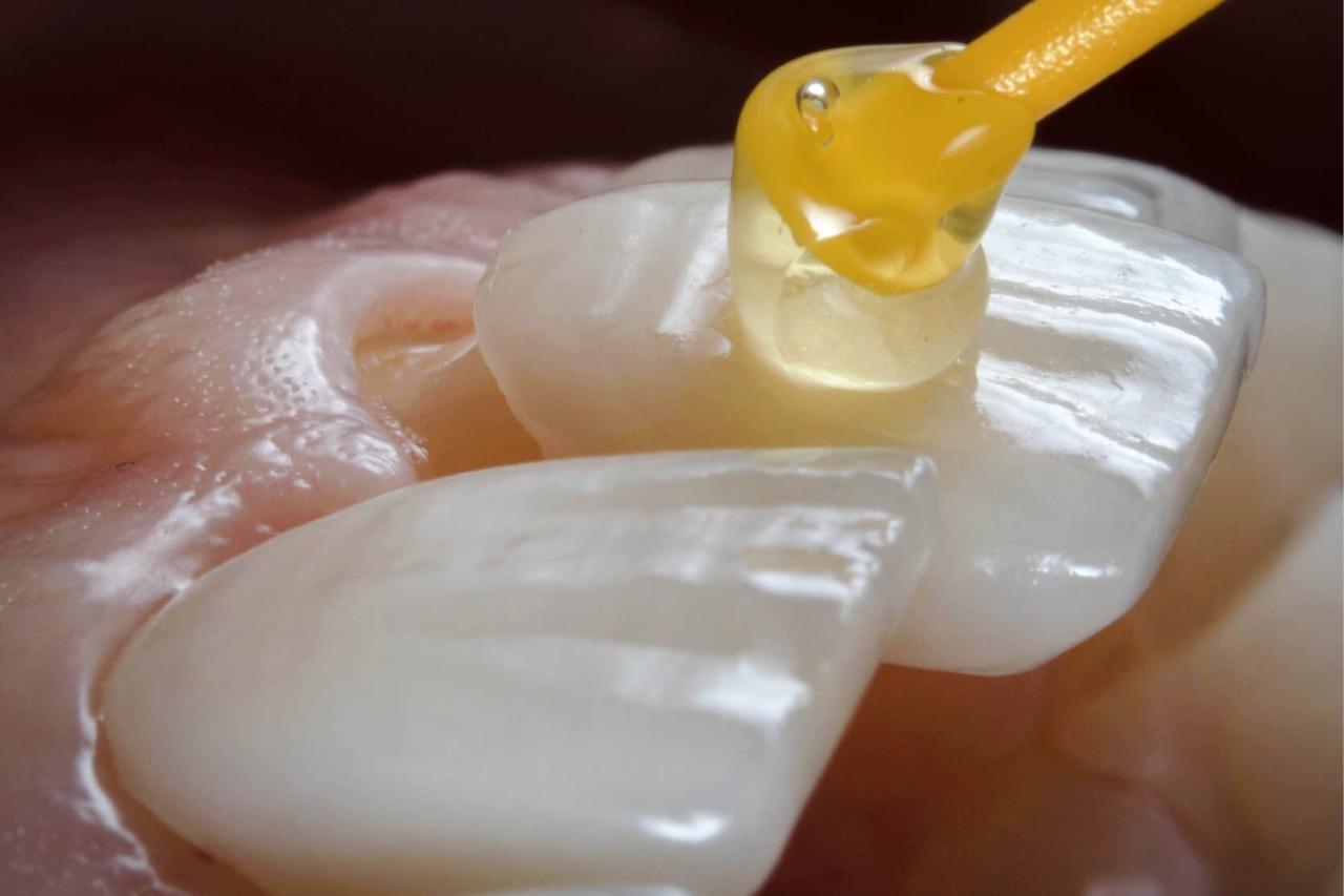 Consiste en colocar unas láminas de porcelana en la cara frontal de los dientes, mejorando su aspecto estético y la sonrisa.