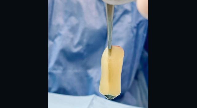 El PRP (PLASMA RICO EN PLAQUETAS) proviene de la misma sangre del paciente