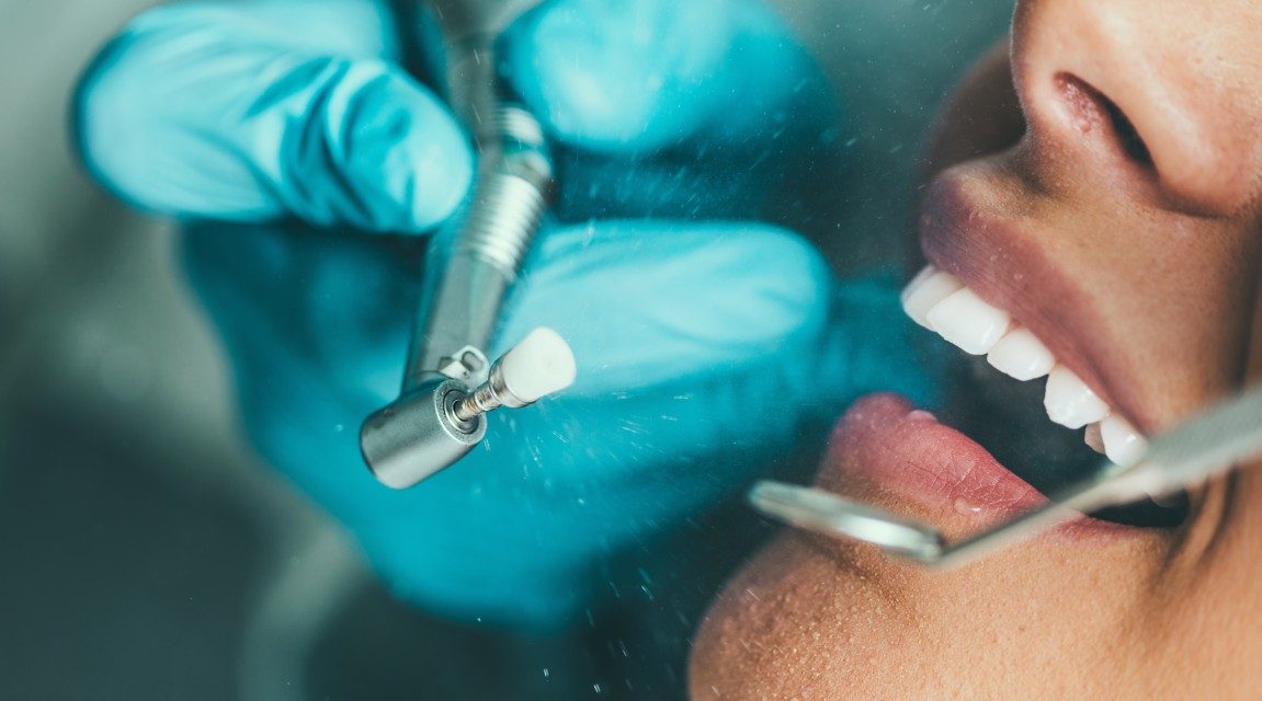 Limpieza dental profesional en Coslada