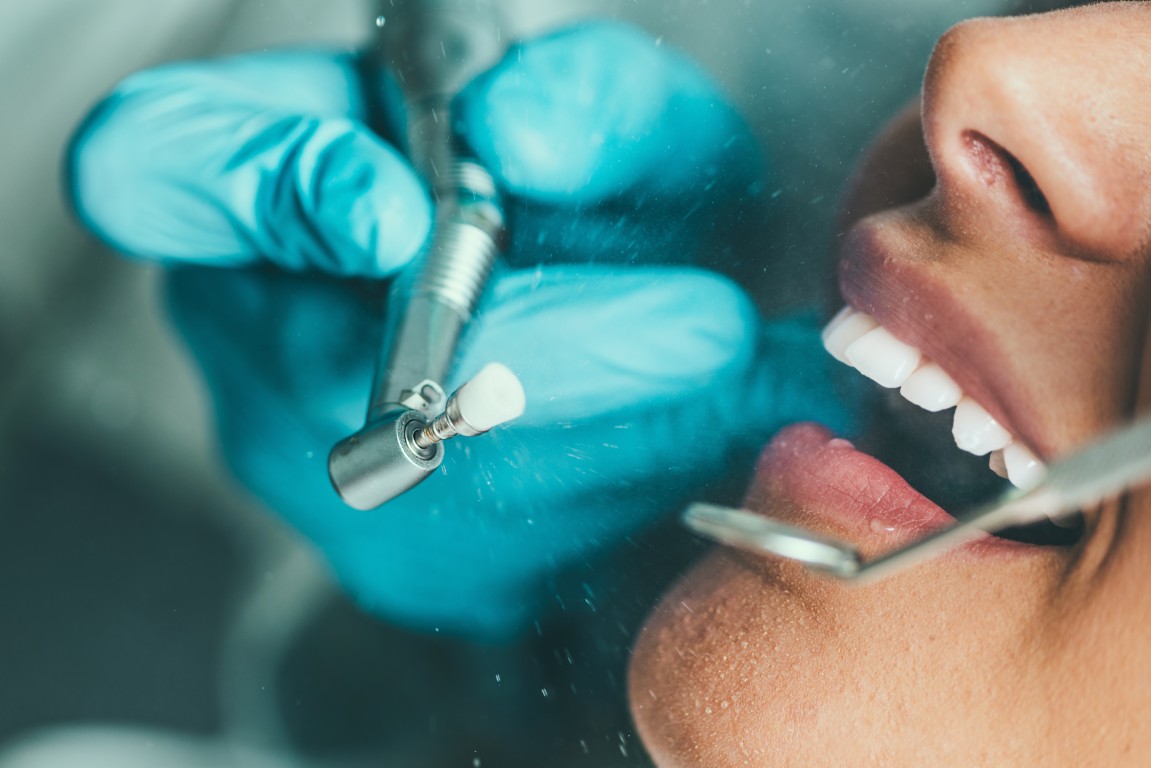 La limpieza dental profesional es uno de los tratamientos preventivos más eficaces para mantener una boca sana. Aunque el cepillado diario es imprescindible