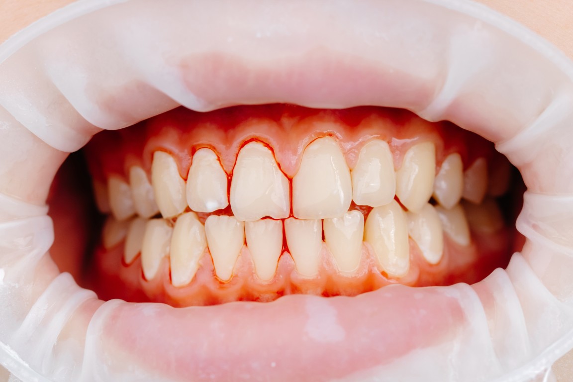 Las encías inflamadas son uno de los primeros signos de que algo no va bien en la salud bucodental. Aunque muchas personas lo pasan por alto