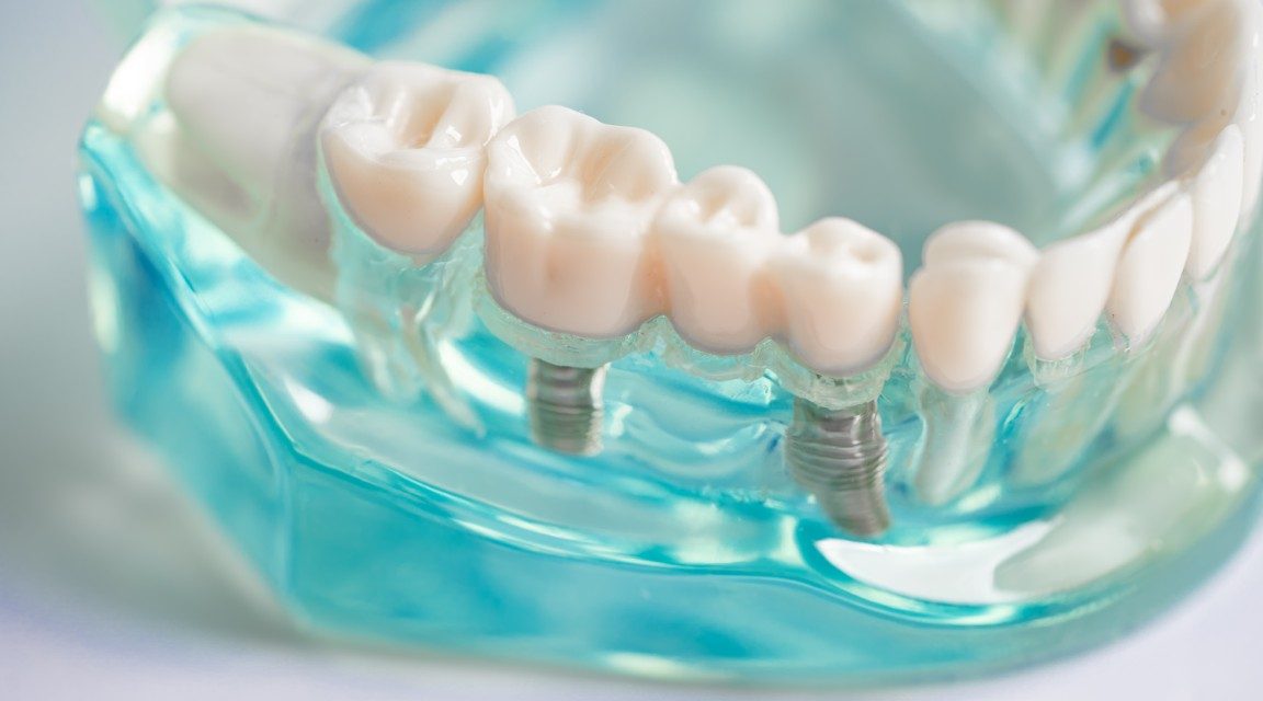 Implantes dentales en Coslada