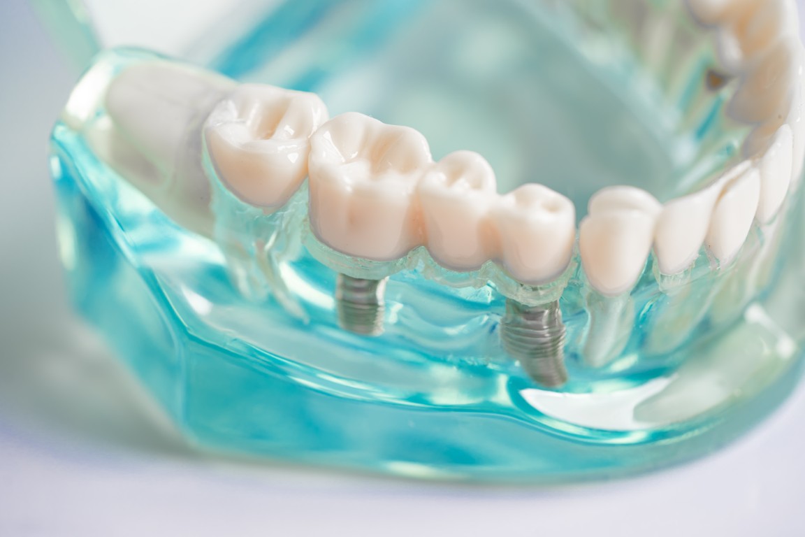 Los implantes dentales son una de las soluciones más fiables y duraderas para reemplazar dientes perdidos.