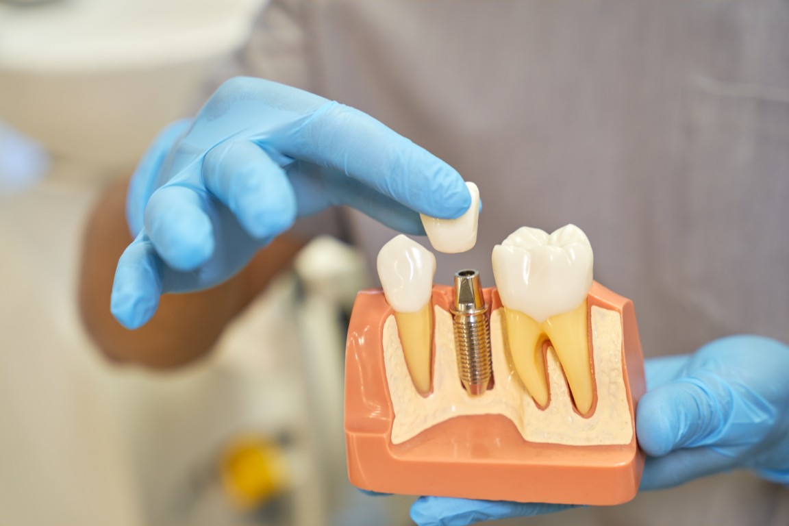 Implantes dentales