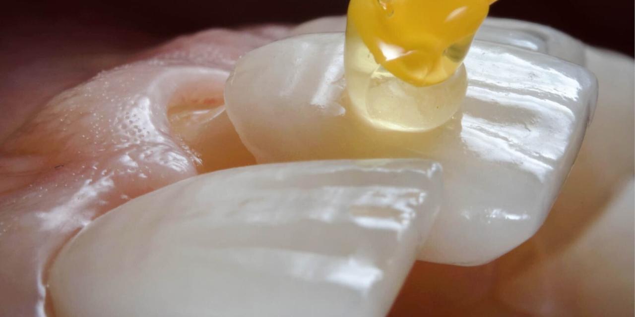 Carillas dentales en Coslada: porcelana o composite, ¿cuál te conviene?
