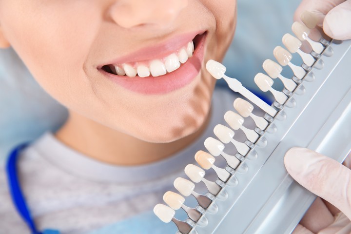 Blanqueamiento dental profesional vs kits de farmacia: lo que nadie te cuenta
